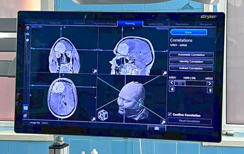 Operație pe creier la Galați, în premieră, realizată cu ajutorul Sistemului de Neuronavigație: Funcționează ca un GPS