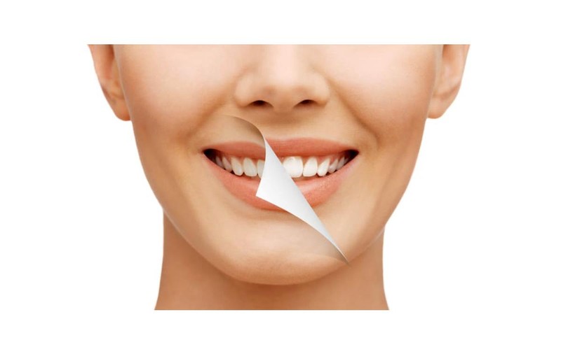 Albirea dentară profesională: ce trebuie să știi înainte de a începe?