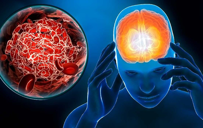 Accidentul vascular cerebral apare cel mai frecvent după o anumită vârstă: cine sunt grupurile cu risc ridicat