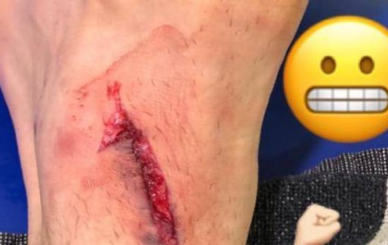 Mario Mandzukici, 10 puncte de sutură, după accidentarea pricinuită de Vecino