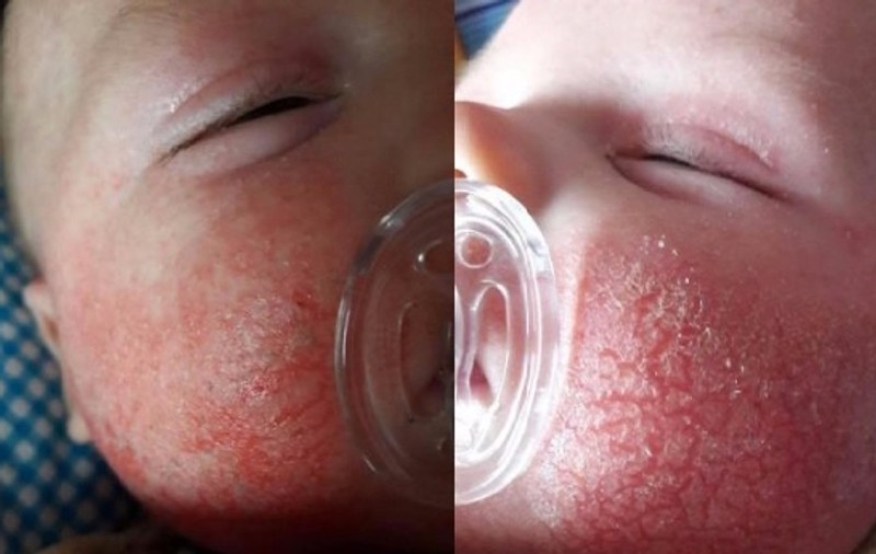 Copilul unui cuplu de români a fost tratat cu creme de medicii englezi deși îi sângera fața