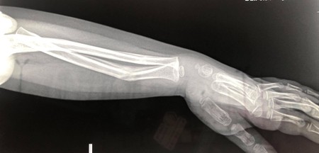Așa arată radiografia mâinii fetiței la mai bine de o lună după intervenție