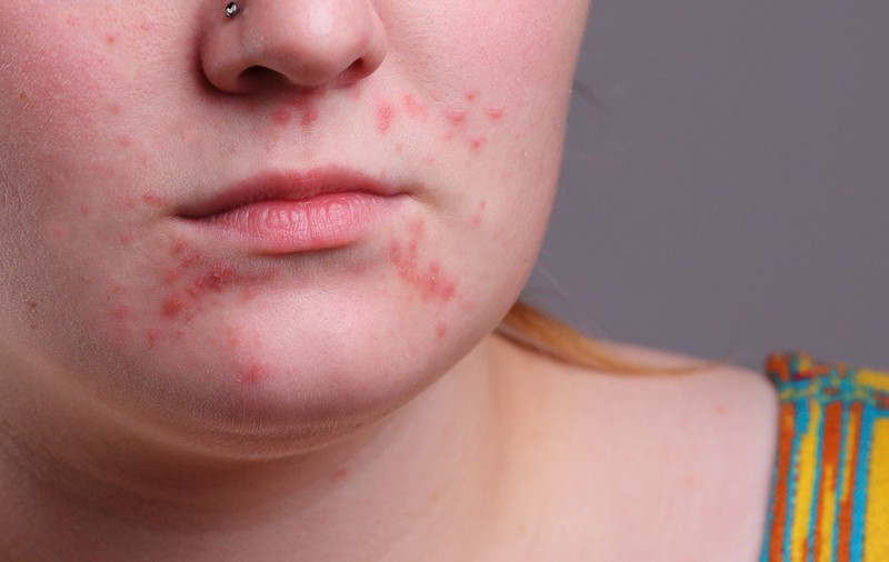 5 alimente sănătoase care înrăutăţesc acneea