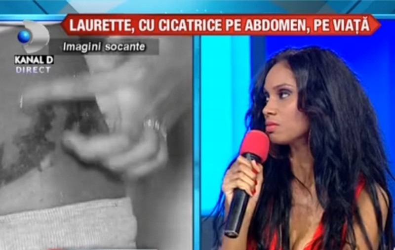 Laurette, traumatizată la un an după ce a fost arsă pe abdomen: «Nu o să mai fac în viața mea o intervenție cu laser»
