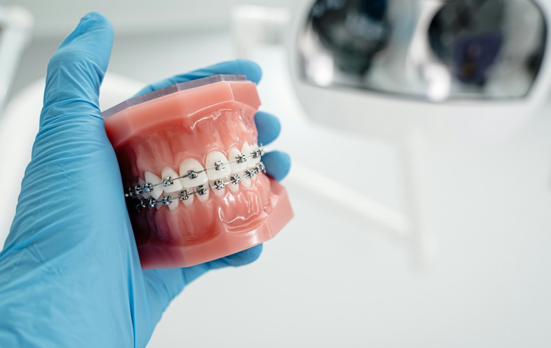 Mituri despre aparatele dentare
