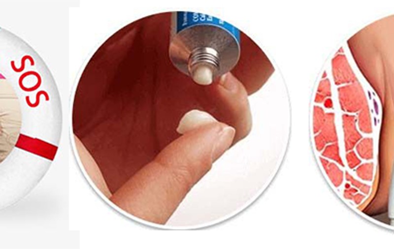 Crema HemorrhoSTOP ne ajuta sa scapam de hemoroizi