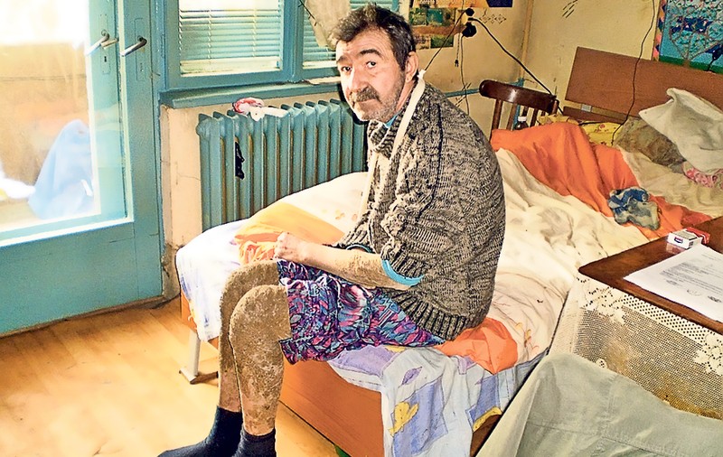 «Omul-şopârlă» a băut clor ca să se omoare