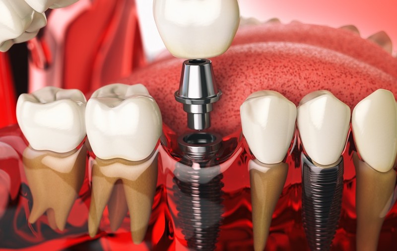 Implanturile dentare: Evoluția și popularitatea lor în restaurarea dentară