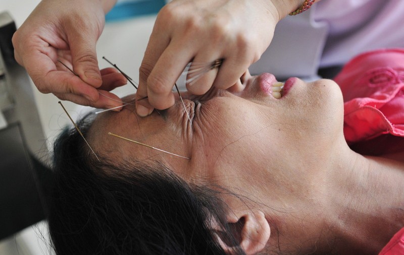 A mers la acupunctură și s-a ales cu un plămân perforat