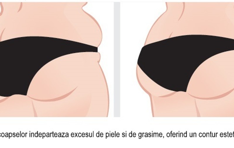 Ultima fiță în materie de intervenții estetice estivale! Află tot despre liftingul de coapse!