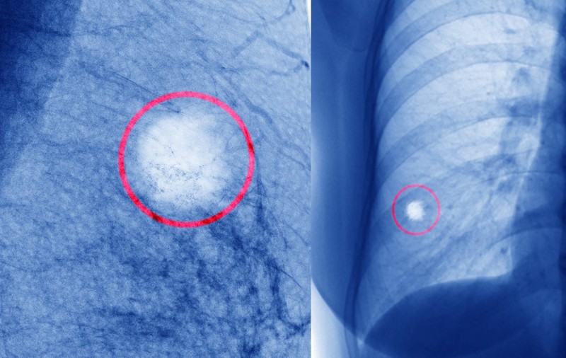 CARE SUNT FACTORII DE RISC AI CANCERULUI DE SÂN