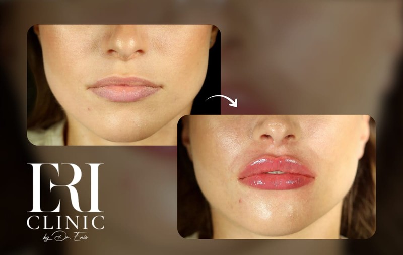 Dăruiește frumusețe: injectarea cu acid hialuronic la Eri Clinic din București, super cadoul dorit