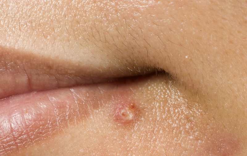 Prea mult par = Hirsutism