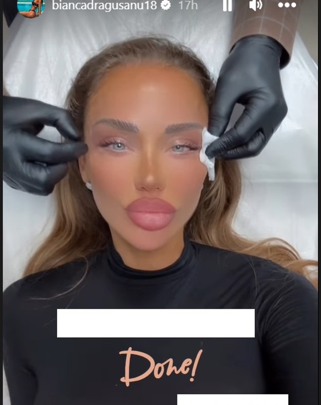 Cum arată Bianca Drăgușanu după cea mai nouă intervenție estetică la față. Ce presupune procedura „cat eye”