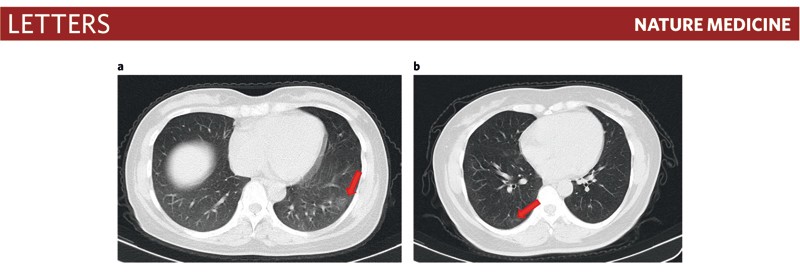 Scanarea CT toracică de la doi pacienți asimptomatici. a. tomografie a unei femei de 45 de ani, care prezintă opacități focale de sticlă la nivelul lobului inferior al plămânului stâng (săgeată). b. scanare CT a unei femei de 50 de ani care prezintă opacități și dungi din sticlă care coexistă în lobul inferior al plămânului drept (săgeată).