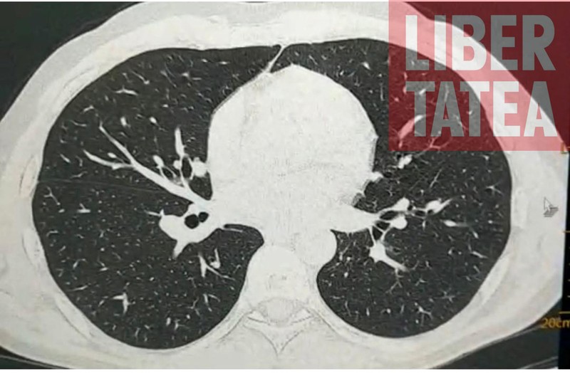 Plămânul normal | Foto: Arhiva laboratorului de imagistică medicală a Institutului de Pneumoftiziologie Marius Nasta