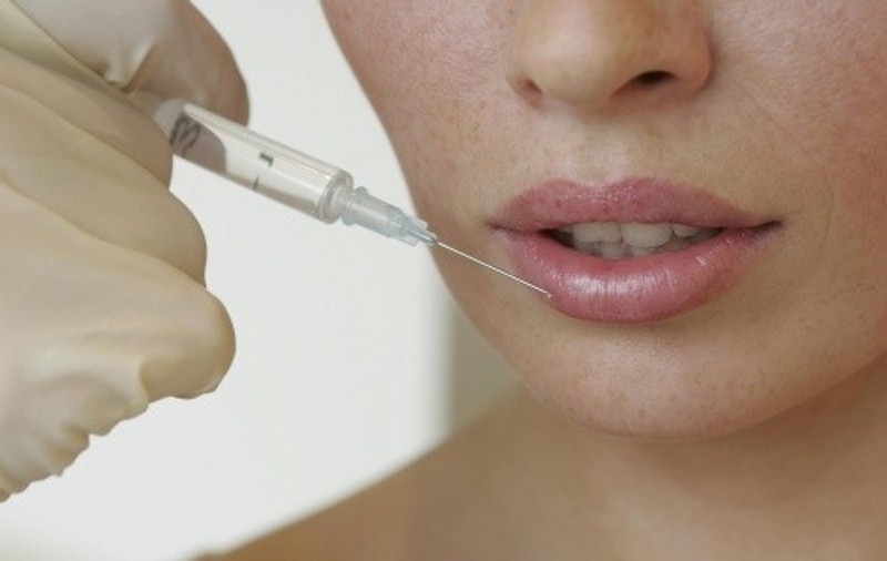 Sănătate şi frumuseţe: Totul despre mărirea buzelor cu acid hialuronic