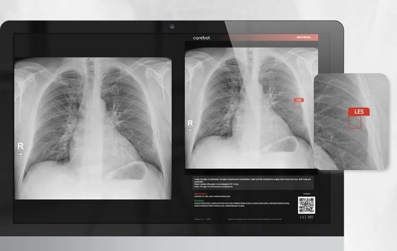 Revoluția silențioasă din radiologia pulmonară care salvează vieți în fiecare zi