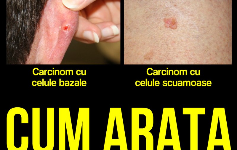 CUM RECUNOȘTI CELE MAI COMUNE TIPURI DE CANCER DE PIELE