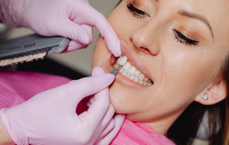 Cum să alegi nuanța potrivită pentru fațetele dentare