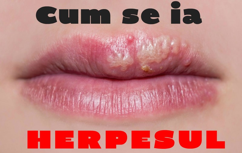 Cum poţi lua herpesul
