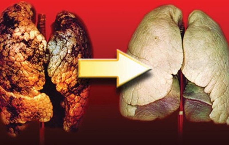 Cum îți cureți plămânii de nicotină și gudron – 4 ingrediente care te ajută