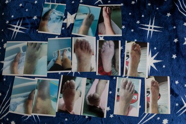 Fotografii făcute în spital cu piciorul bolnav al lui Stelu Stoica
