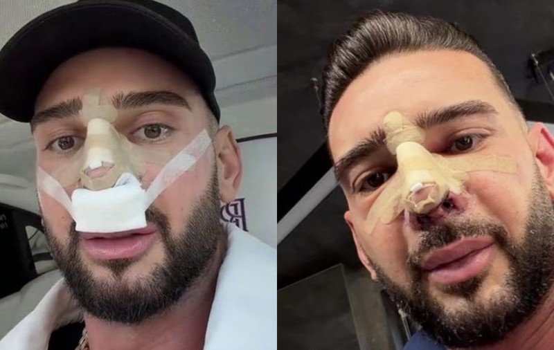 Cum arată nasul lui Dorian Popa la 12 zile de la operație. Și-a dat bandajul jos: „Cum nici nu am visat”