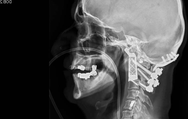 Au reuşit prima operaţie cu vertebră artificială, printată 3D