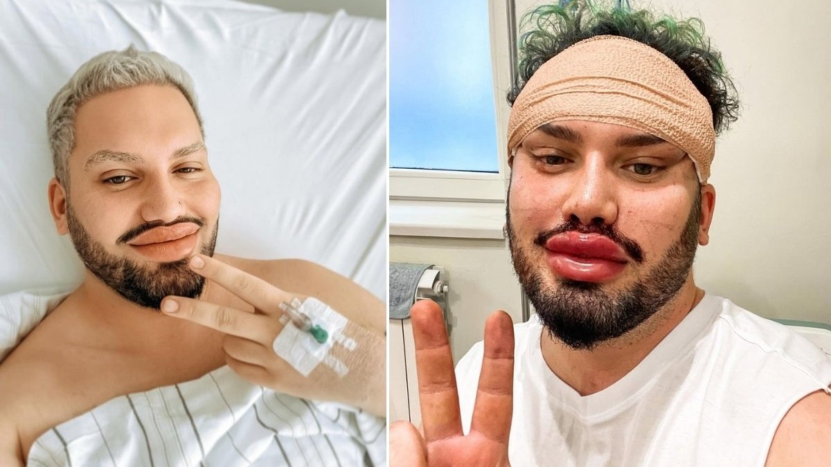 colaj foto format din două imagini: imaginea din stânga arata un bărbat cu p branulă în mână, pe patul de spital, zâmbind iar imaginea din dreapta arată același bărbat, cu bandaje pe cap și cusături în jurul ochilor