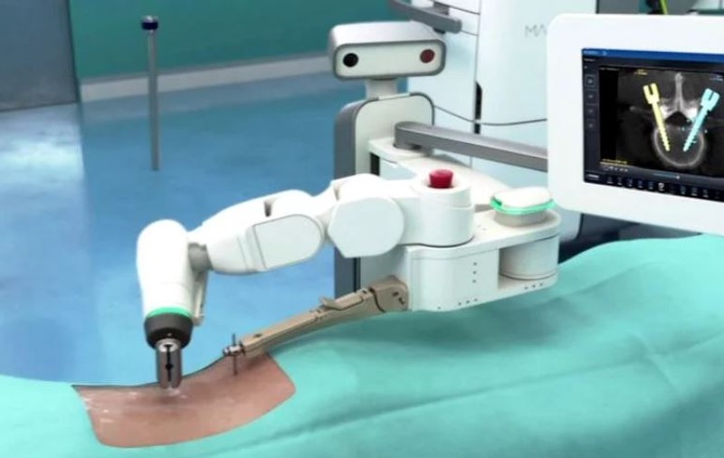 Prima operație cu cel mai performant robot de neurochirurgie, la Iași. Cum acționează Mazor X