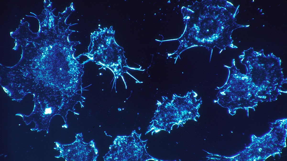 tratament de cancer la sân
