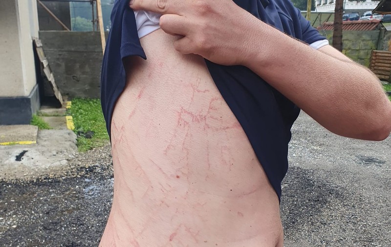 FOTO. Semnele lăsate pe corpul unui om de un fulger care a lovit în apropierea acestuia. Sfaturile salvamontiştilor
