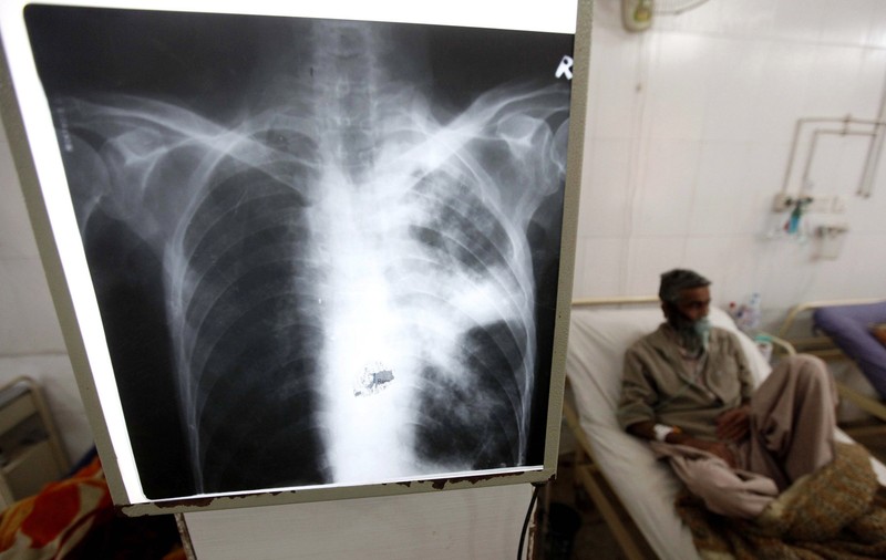 După cancere nediagnosticate, o altă scădere a avut loc pentru că oamenii au evitat spitalele în pandemie: cu 35% mai puțini pacienți descoperiți cu TBC