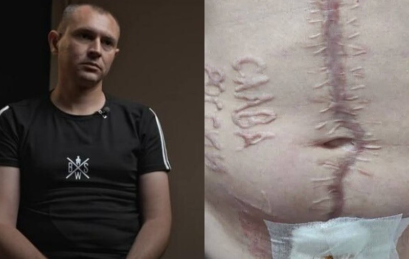 Andrei, soldatul care a fost ars pe abdomen cu inscripția „Glorie Rusiei”: „E opera unui sadic chirurg rus. Ca să nu uit unde am fost”