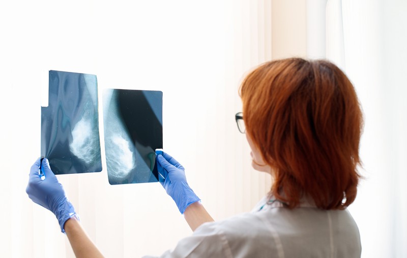 Zero mamografii decontate în nouă județe din țară anul trecut. În Suceava, peste o sută de femei au murit de cancer la sân în 2020