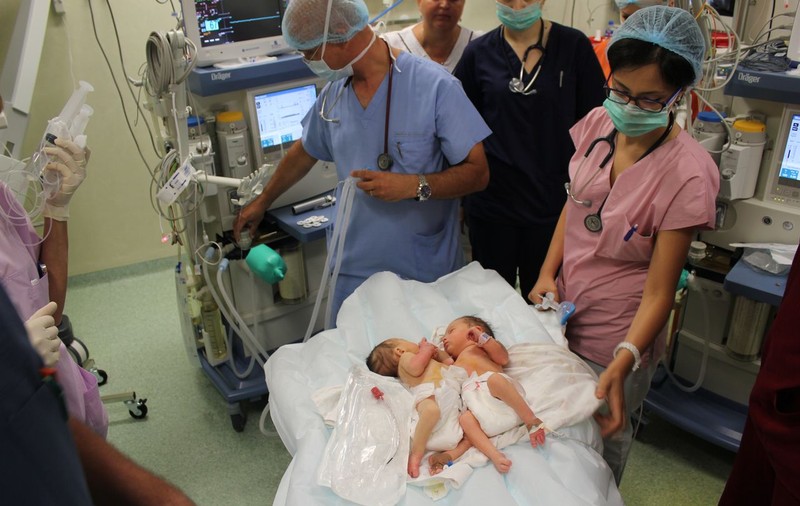 Siamezele de la Braşov, operate cu succes la Marie Curie