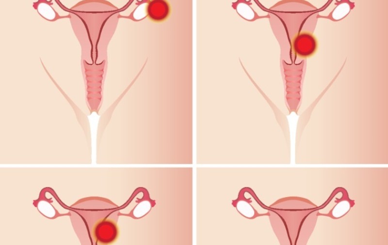 EFECTELE CAFELEI ASUPRA CICLULUI MENSTRUAL
