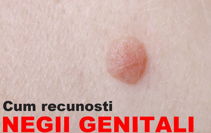 Cum știi că ai negi genitali