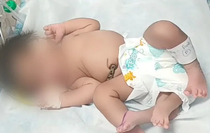 O femeie din India a născut un copil cu patru picioare. Ce decizie au luat medicii