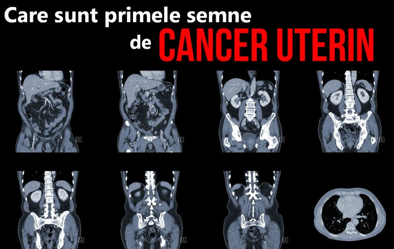 Simptomele cancerului uterin. Vezi care sunt primele semne