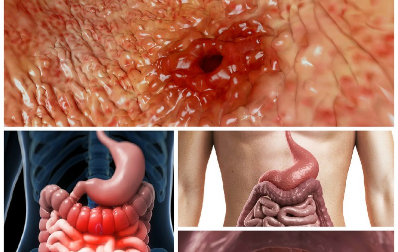CUM ÎŢI DAI SEAMA DACĂ AI ULCER LA STOMAC