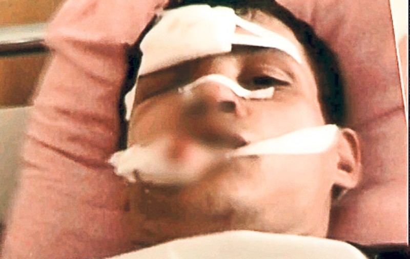 Uite cât de simplu poți rămâne fără dinți | Știrbit de doctori din greșeală