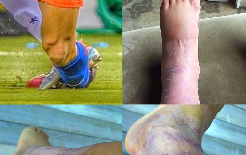 Nu e deloc ușoară viața de fotbalist! Imagini horror cu picioarele unui proaspăt câștigător al Copei America