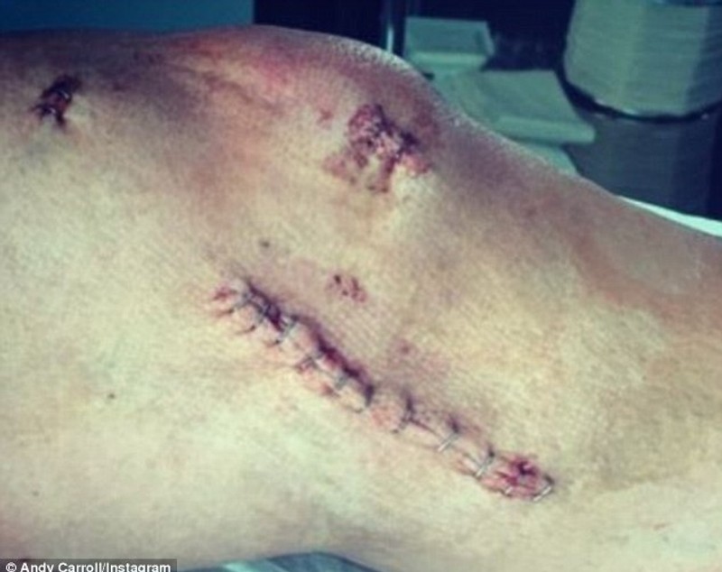 Imagini HORROR cu piciorul atacantului Andy Carroll /  GALERIE FOTO