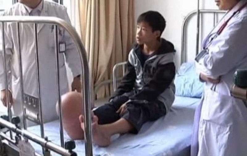 Un copil din China a ŞOCAT lumea medicală! Vezi ce boală rară are şi cum îi arată picioarele! | VIDEO