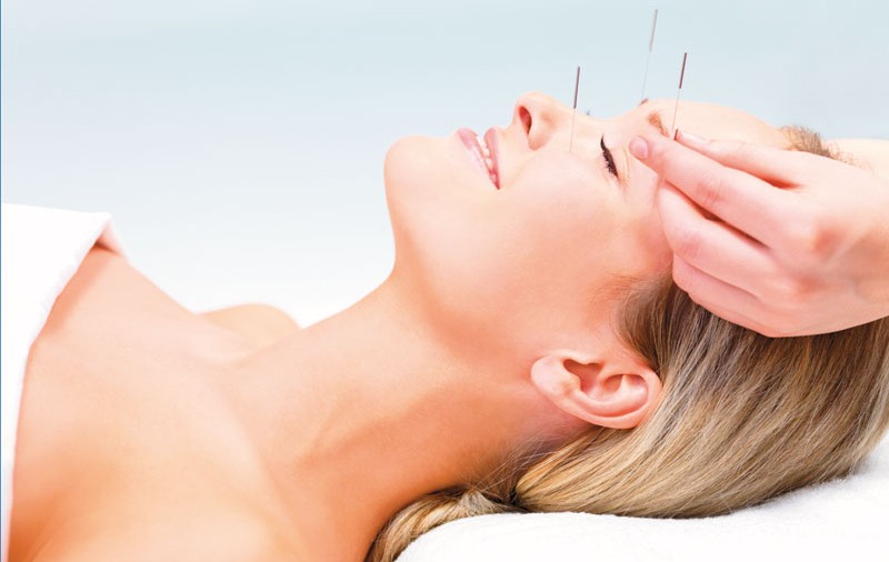 Scapă de migrene cu acupunctură