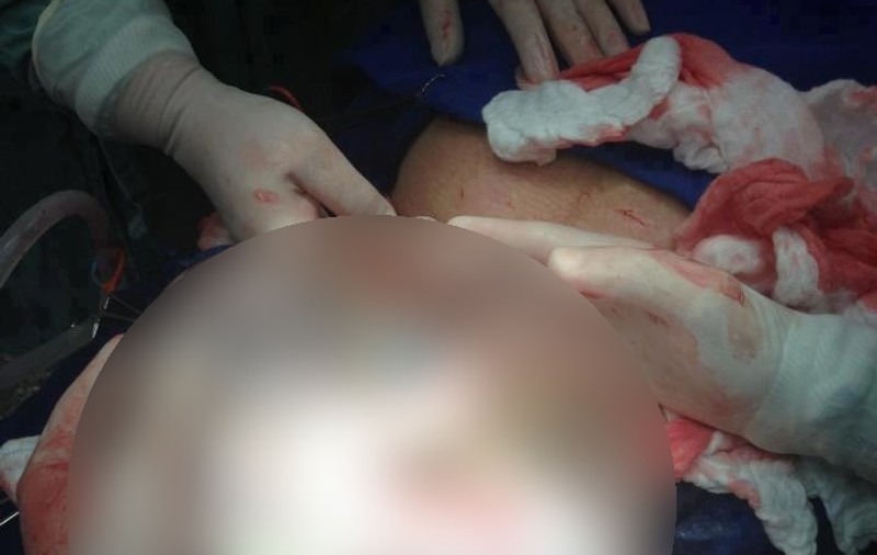 ŞOCANT! Naşterea CARE LE-A TĂIAT RĂSUFLAREA MEDICILOR! Uite cum a venit pe lume acest bebeluş | FOTO ÎN ARTICOL