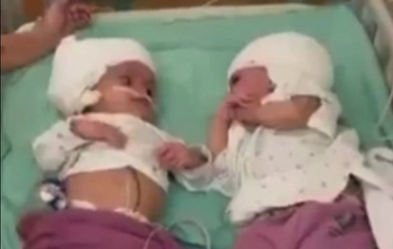 Siameze unite în zona capului, separate după o operație de 12 ore, în Israel