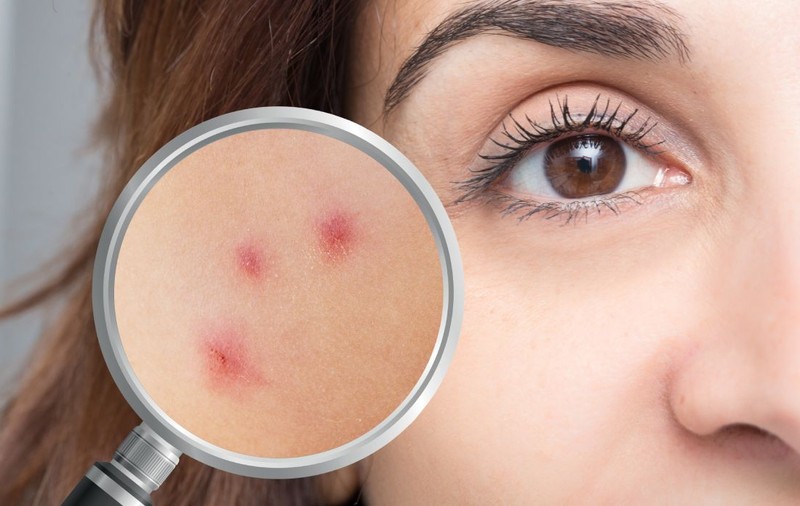 Să nu te plângi niciodată că ești singur: pe piele trăiesc mii de „musafiri” invizibili. Ce este Demodex, acarianul care umblă noaptea pe fața ta